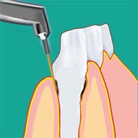 Zahnfleischbehandlung und der Schleimhautentzündung
